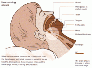 Eliminate The Horrible Sound Of Snoring Through A Snoring Mouth Guard
