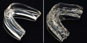 snoring mouthpiece before and after molding snoring mouthpiece before and after molding
