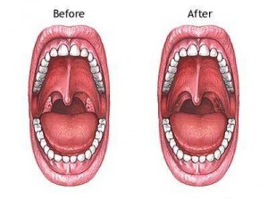 ways to prevent snoring