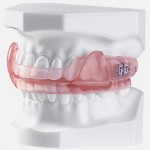 How Long Does it Take to Get Used to a Snore Mouth Guard Snoring Solutions.jpg
