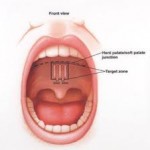 Palatal Implants As Snoring Solutions