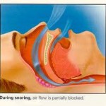 CPAP Can Prevent Sleep Apnea And Snoring