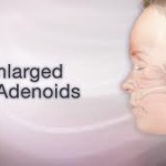 Enlarged Adenoids And Snoring In Children
