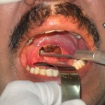 Laser Surgery for Snoring.jpg