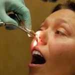 Septoplasty To Cure Snoring