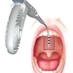 Pillar Procedure for Snoring and Sleep Apnea