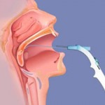 Pillar Implants